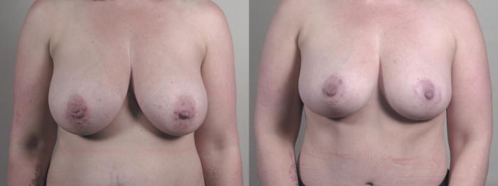 Tummy Tuck Case 1515 Before & After front 2 | Paramus, New Jersey | Parker Center for Plastic Surgery