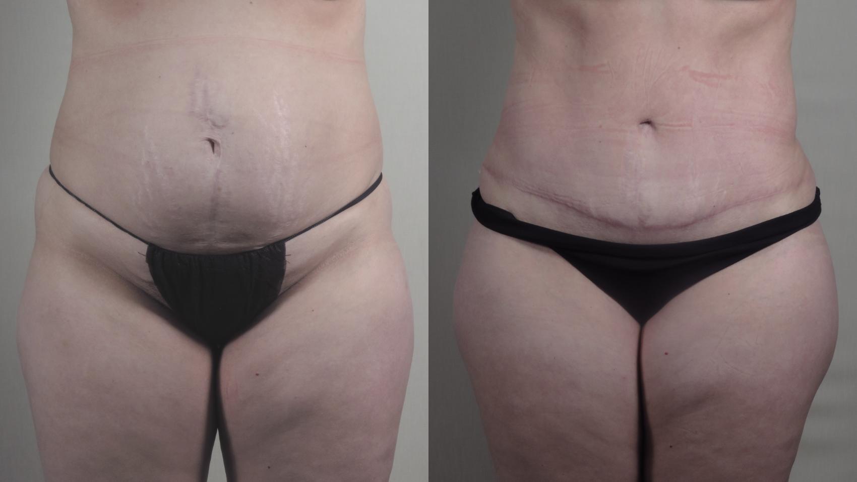 Tummy Tuck Case 1515 Before & After Front | Paramus, New Jersey | Parker Center for Plastic Surgery