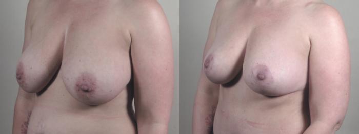 Tummy Tuck Case 1515 Before & After Left Oblique | Paramus, New Jersey | Parker Center for Plastic Surgery