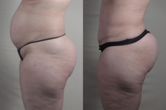 Tummy Tuck Case 1515 Before & After Left Side | Paramus, New Jersey | Parker Center for Plastic Surgery