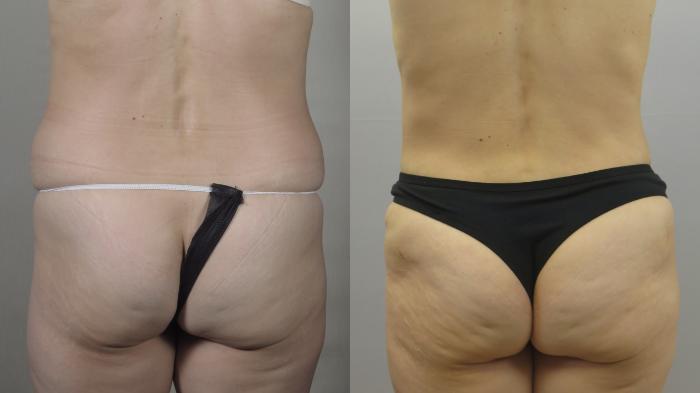 Tummy Tuck Case 1557 Before & After Back | Paramus, New Jersey | Parker Center for Plastic Surgery