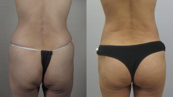 Tummy Tuck Case 1566 Before & After Back | Paramus, New Jersey | Parker Center for Plastic Surgery