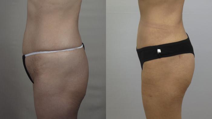 Tummy Tuck Case 1566 Before & After Left Side | Paramus, New Jersey | Parker Center for Plastic Surgery