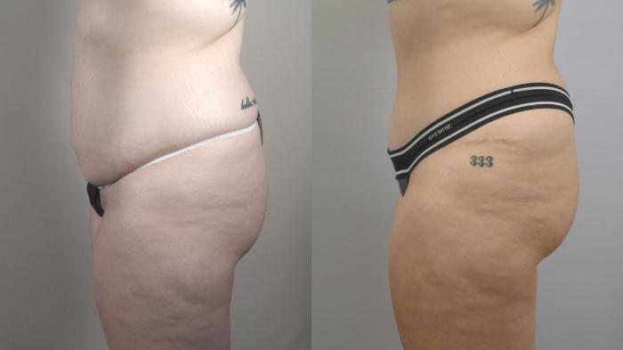 Tummy Tuck Case 1578 Before & After Left Side | Paramus, New Jersey | Parker Center for Plastic Surgery