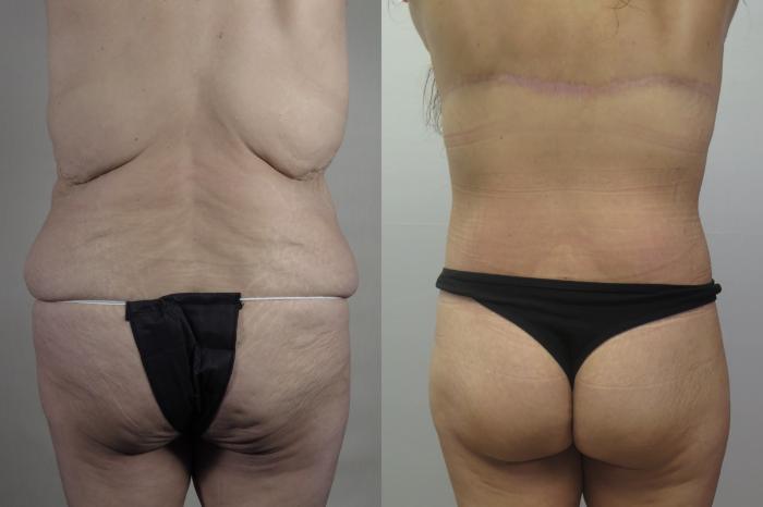 Tummy Tuck Case 1584 Before & After Back | Paramus, New Jersey | Parker Center for Plastic Surgery