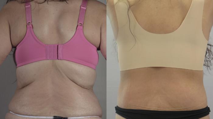 Tummy Tuck Case 1584 Before & After bra line | Paramus, New Jersey | Parker Center for Plastic Surgery