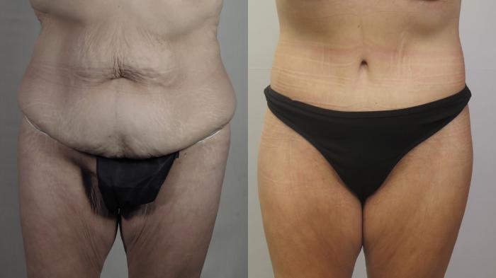 Tummy Tuck Case 1584 Before & After Front | Paramus, New Jersey | Parker Center for Plastic Surgery