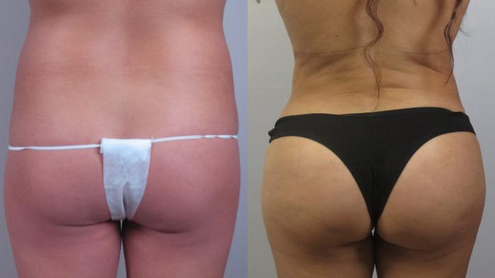 Tummy Tuck Case 1601 Before & After Back | Paramus, New Jersey | Parker Center for Plastic Surgery