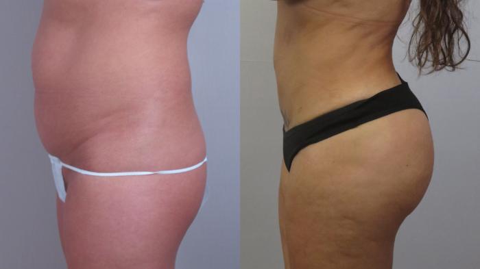 Tummy Tuck Case 1601 Before & After Left Side | Paramus, New Jersey | Parker Center for Plastic Surgery