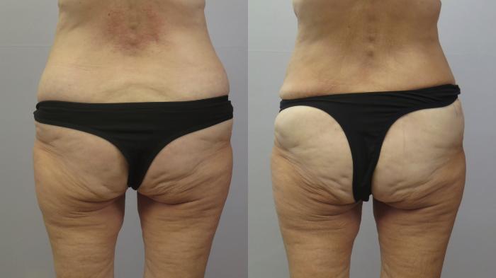 Tummy Tuck Case 1612 Before & After Back | Paramus, New Jersey | Parker Center for Plastic Surgery
