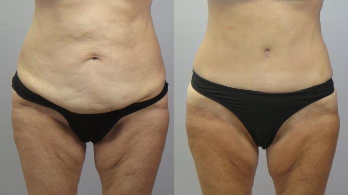 Tummy Tuck Case 1612 Before & After Front | Paramus, New Jersey | Parker Center for Plastic Surgery