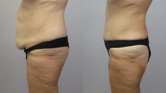 Tummy Tuck Case 1612 Before & After Left Side | Paramus, New Jersey | Parker Center for Plastic Surgery