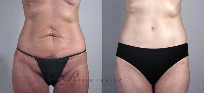 Liposuction Case 555 Before & After View #1 | Paramus, NJ | Parker Center for Plastic Surgery