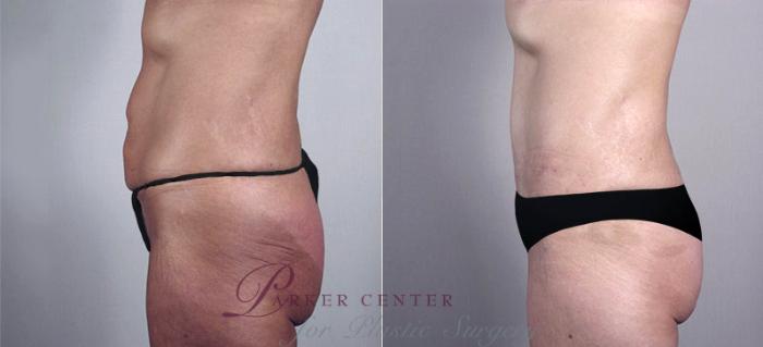 Liposuction Case 555 Before & After View #2 | Paramus, NJ | Parker Center for Plastic Surgery