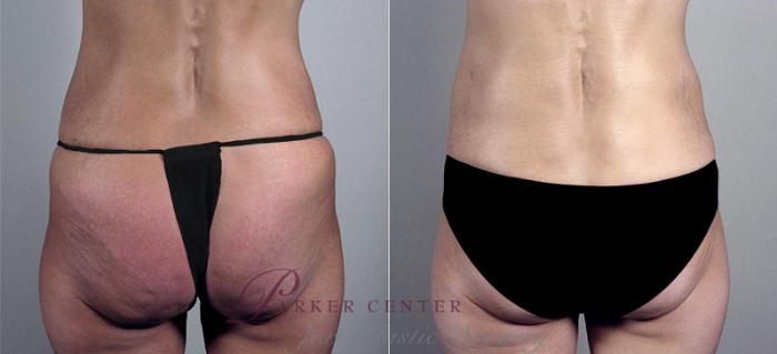 Liposuction Case 555 Before & After View #3 | Paramus, NJ | Parker Center for Plastic Surgery