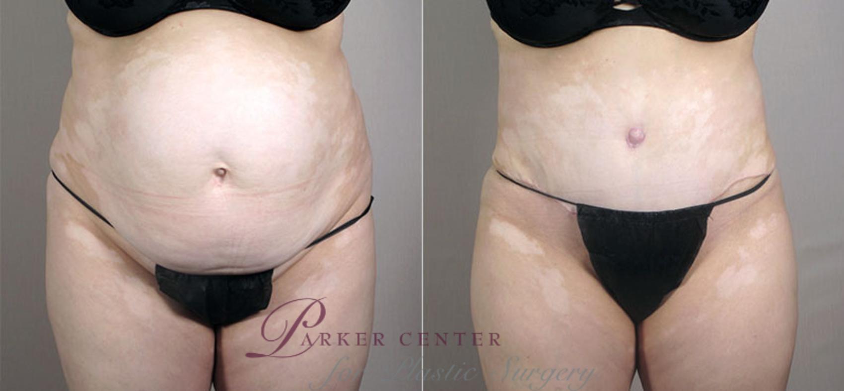Liposuction Case 557 Before & After View #1 | Paramus, NJ | Parker Center for Plastic Surgery