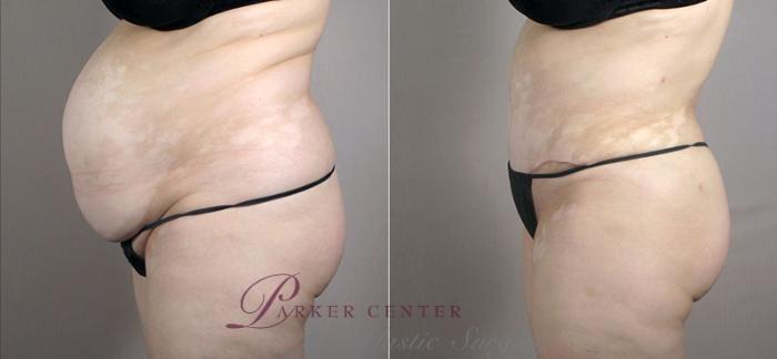 Liposuction Case 557 Before & After View #2 | Paramus, NJ | Parker Center for Plastic Surgery