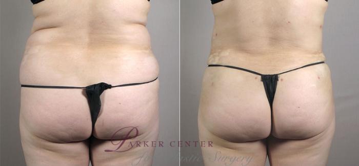 Liposuction Case 557 Before & After View #3 | Paramus, NJ | Parker Center for Plastic Surgery