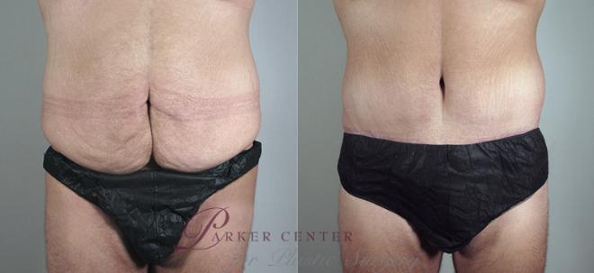 Tummy Tuck Case 681 Before & After View #1 | Paramus, NJ | Parker Center for Plastic Surgery