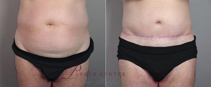 Liposuction Case 683 Before & After View #1 | Paramus, NJ | Parker Center for Plastic Surgery