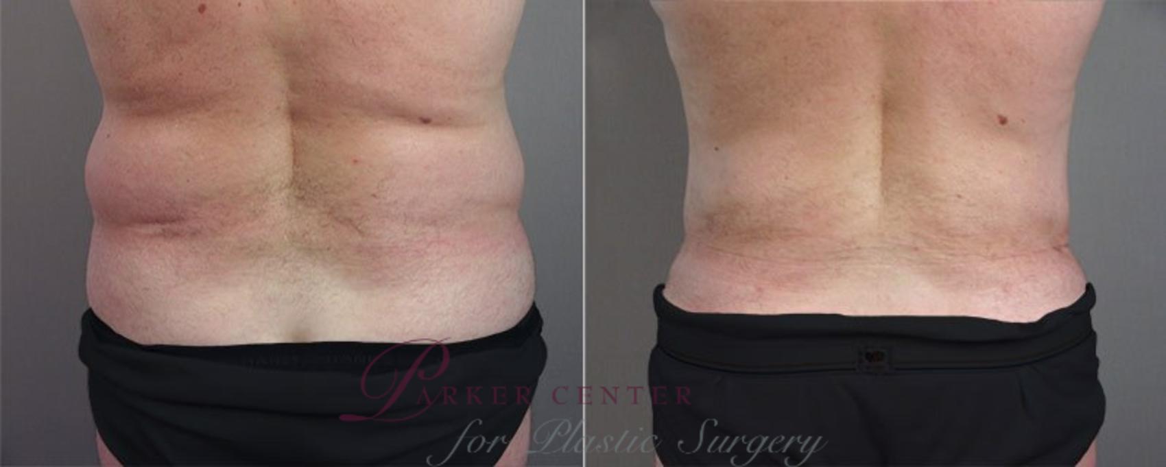 Abdominoplasty Case 683 Before & After View #2 | Paramus, NJ | Parker Center for Plastic Surgery