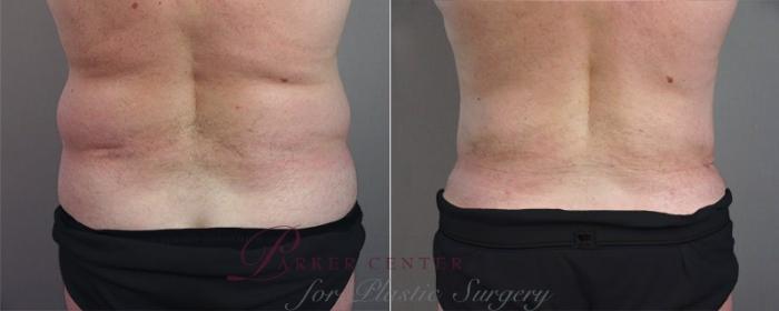 Liposuction Case 683 Before & After View #2 | Paramus, NJ | Parker Center for Plastic Surgery