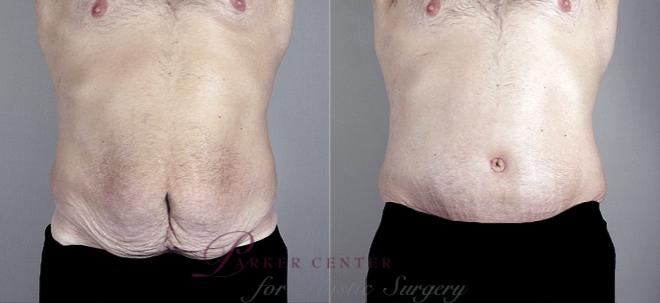 Liposuction Case 684 Before & After View #1 | Paramus, NJ | Parker Center for Plastic Surgery