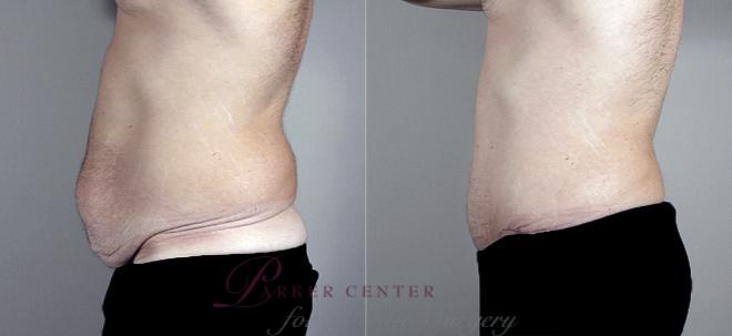 Liposuction Case 684 Before & After View #2 | Paramus, NJ | Parker Center for Plastic Surgery