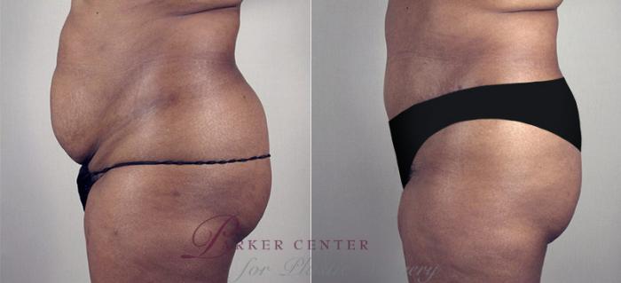 Tummy Tuck Case 686 Before & After View #1 | Paramus, NJ | Parker Center for Plastic Surgery