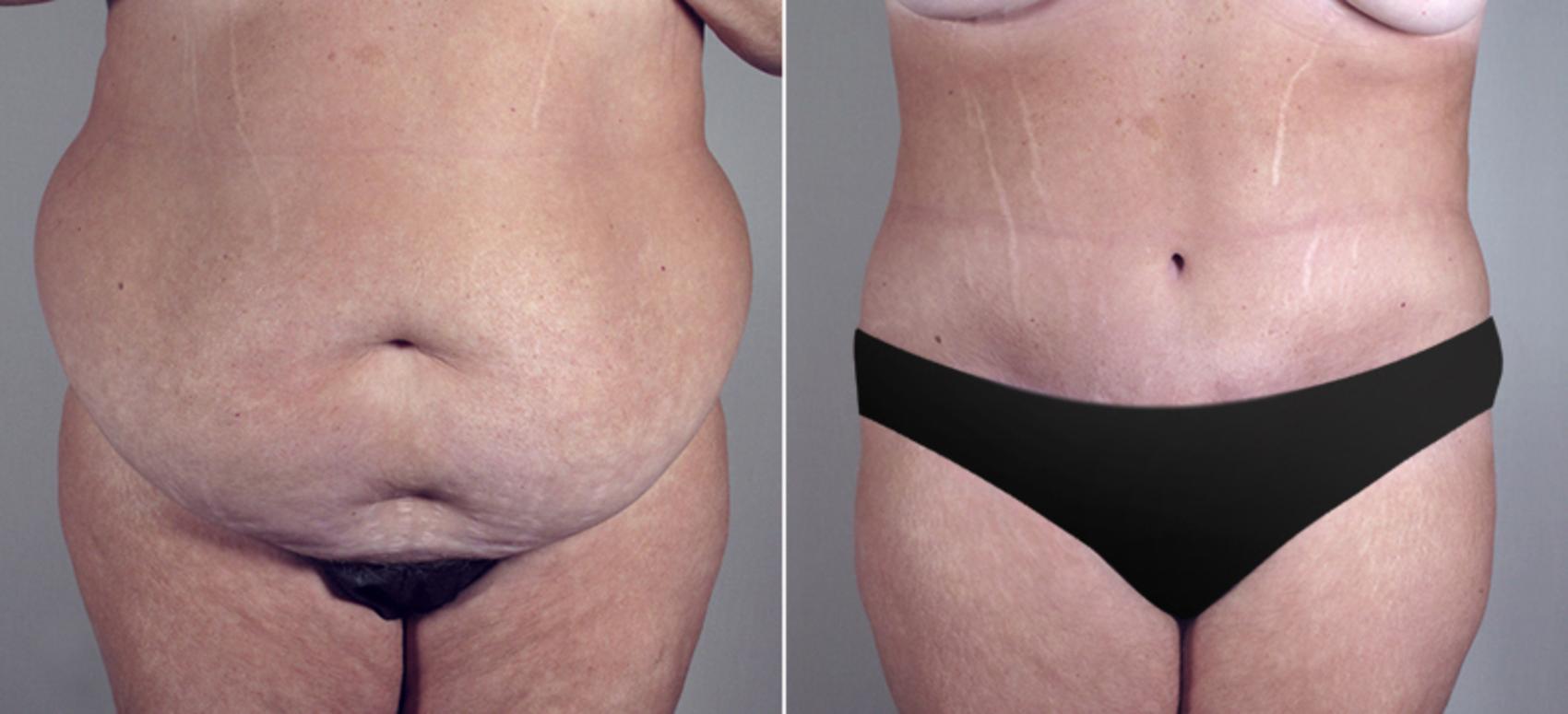 Tummy Tuck Case 687 Before & After View #1 | Paramus, New Jersey | Parker Center for Plastic Surgery