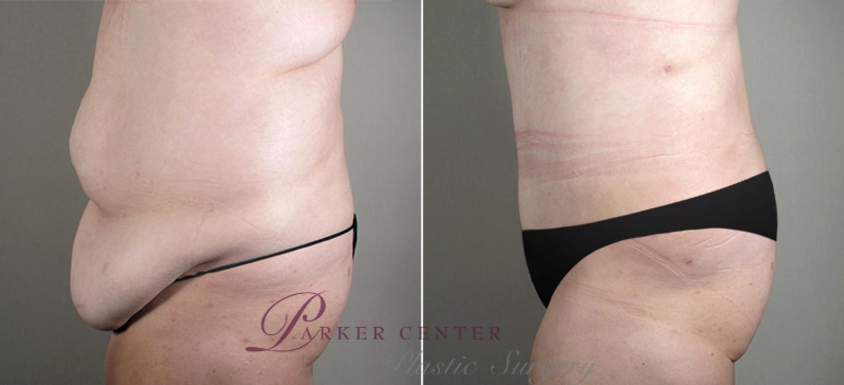 Tummy Tuck Case 688 Before & After View #2 | Paramus, New Jersey | Parker Center for Plastic Surgery