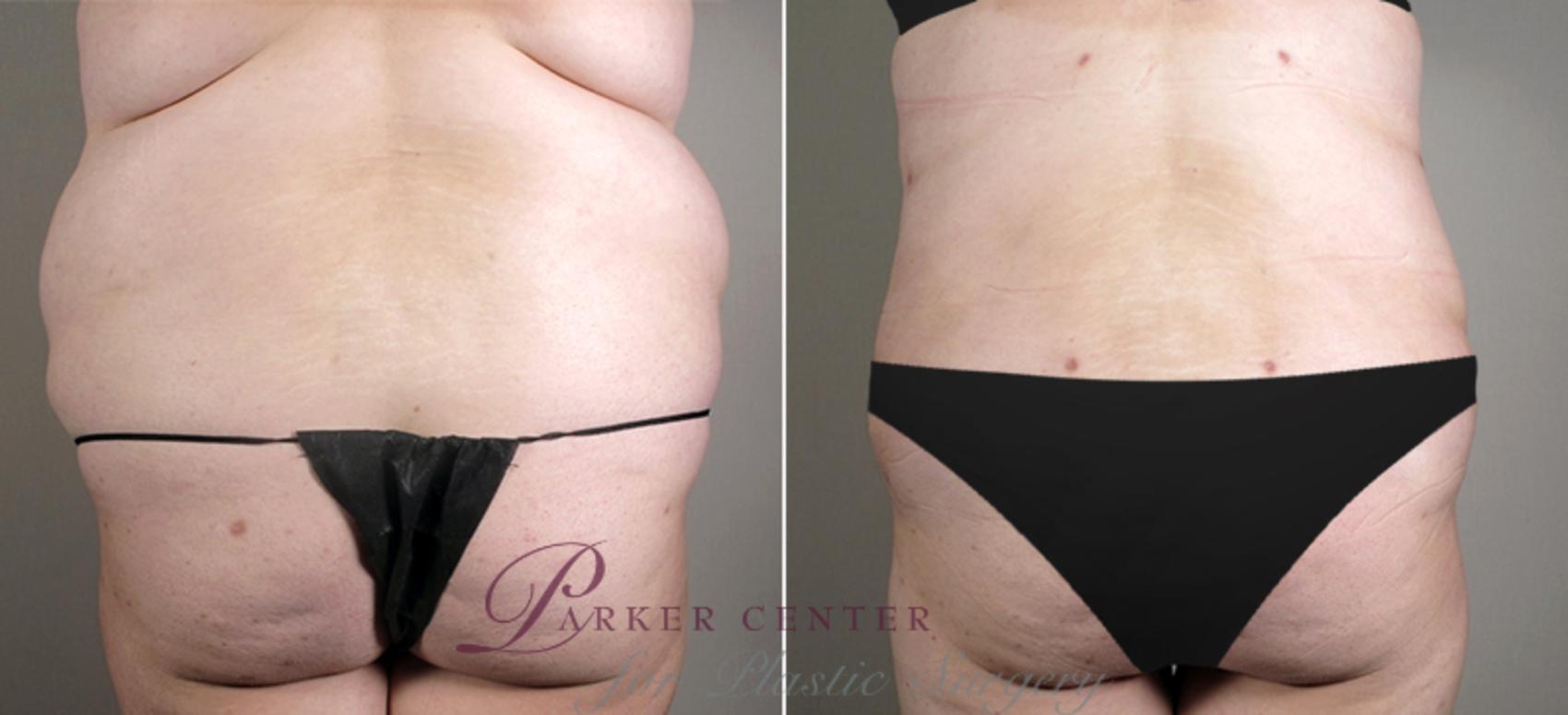 Tummy Tuck Case 688 Before & After View #3 | Paramus, New Jersey | Parker Center for Plastic Surgery