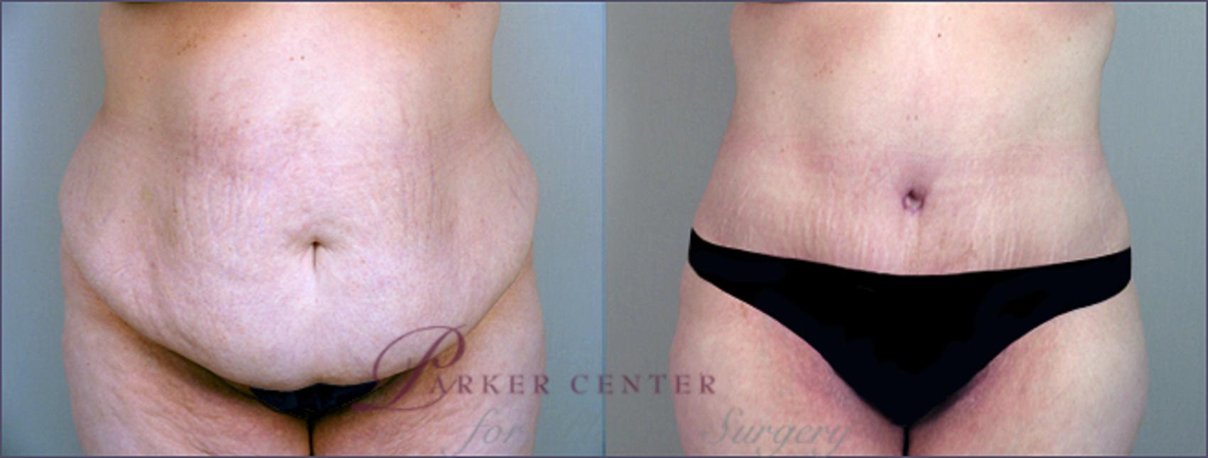Tummy Tuck Case 689 Before & After View #1 | Paramus, NJ | Parker Center for Plastic Surgery