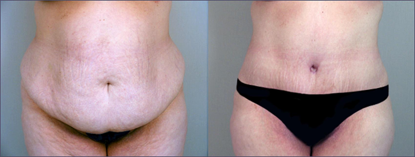 Liposuction Case 689 Before & After View #1 | Paramus, NJ | Parker Center for Plastic Surgery