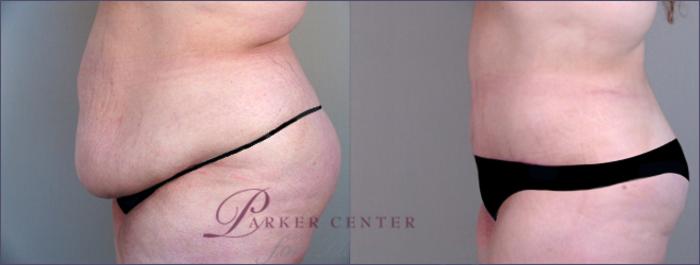 Tummy Tuck Case 689 Before & After View #2 | Paramus, NJ | Parker Center for Plastic Surgery