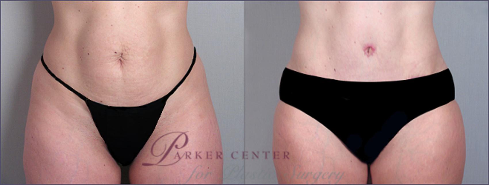 Liposuction Case 690 Before & After View #1 | Paramus, NJ | Parker Center for Plastic Surgery