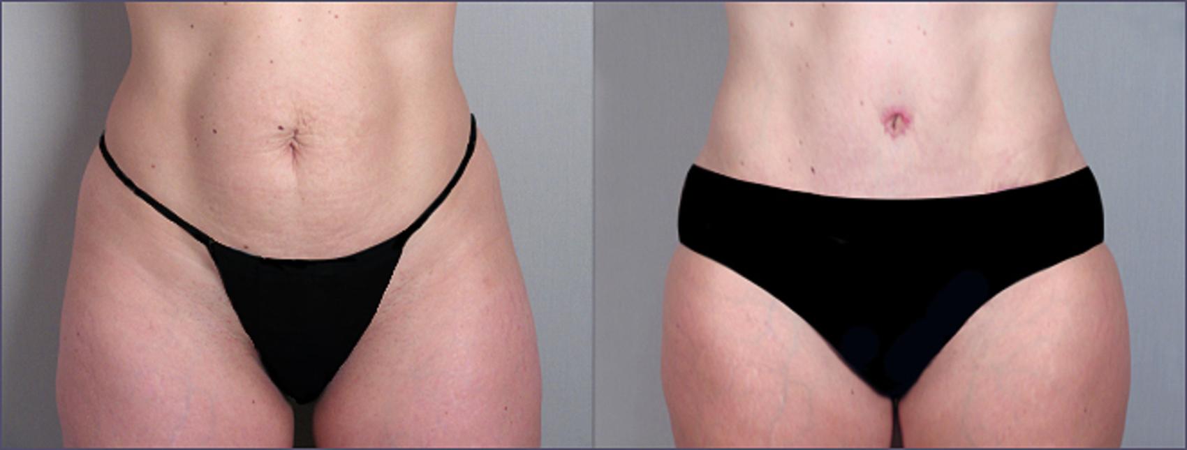 Tummy Tuck Case 690 Before & After View #1 | Paramus, NJ | Parker Center for Plastic Surgery