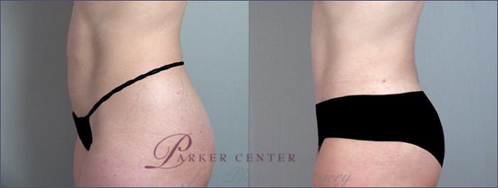 Liposuction Case 690 Before & After View #2 | Paramus, NJ | Parker Center for Plastic Surgery