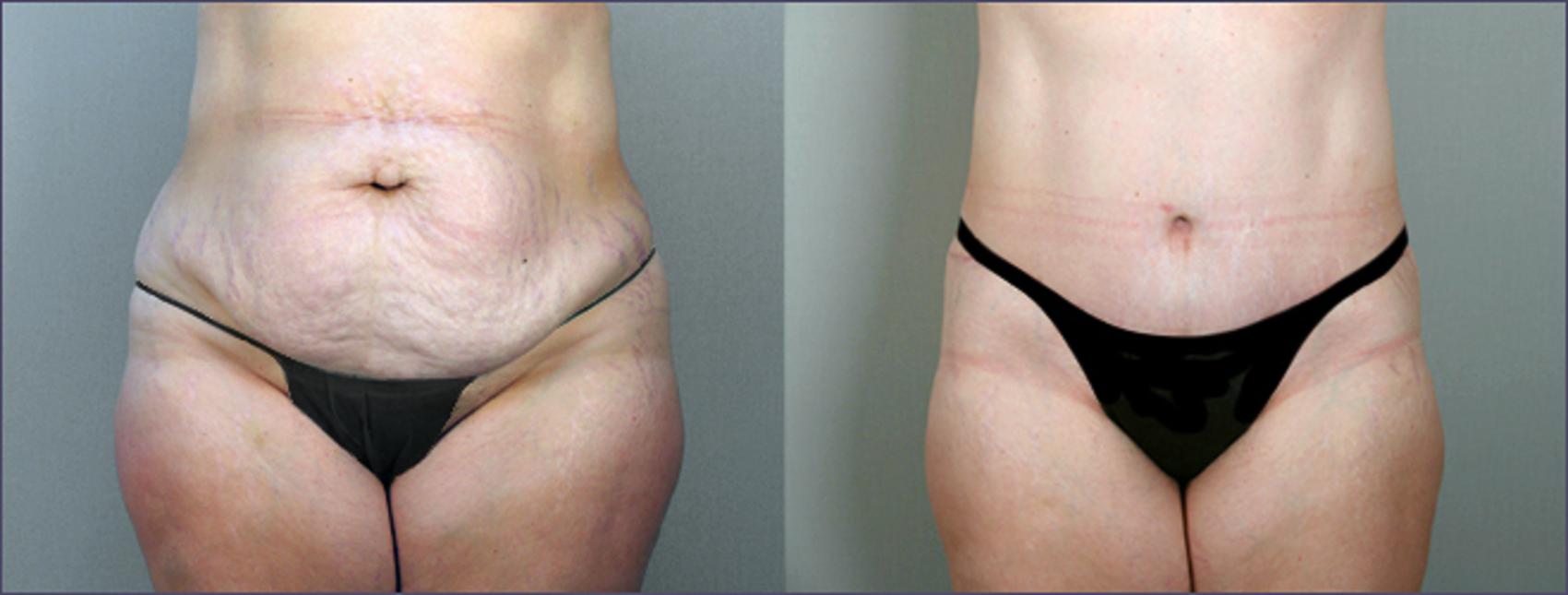 All About Tummy Tuck Scars  Spring Ridge Plastic Surgery