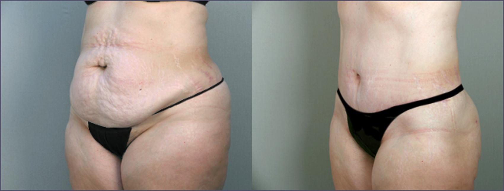 Tummy Tuck Case 692 Before & After View #2 | Paramus, NJ | Parker Center for Plastic Surgery