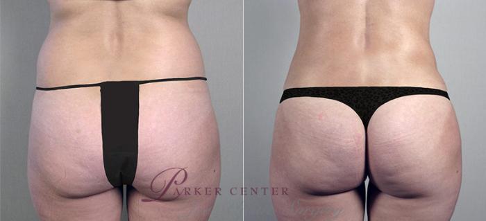 Liposuction Case 694 Before & After View #1 | Paramus, NJ | Parker Center for Plastic Surgery