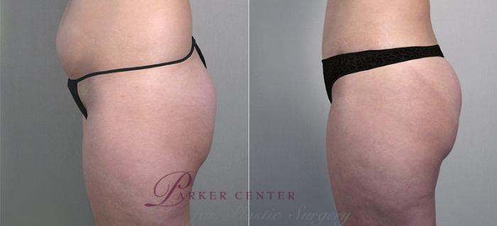 Liposuction Case 694 Before & After View #2 | Paramus, NJ | Parker Center for Plastic Surgery