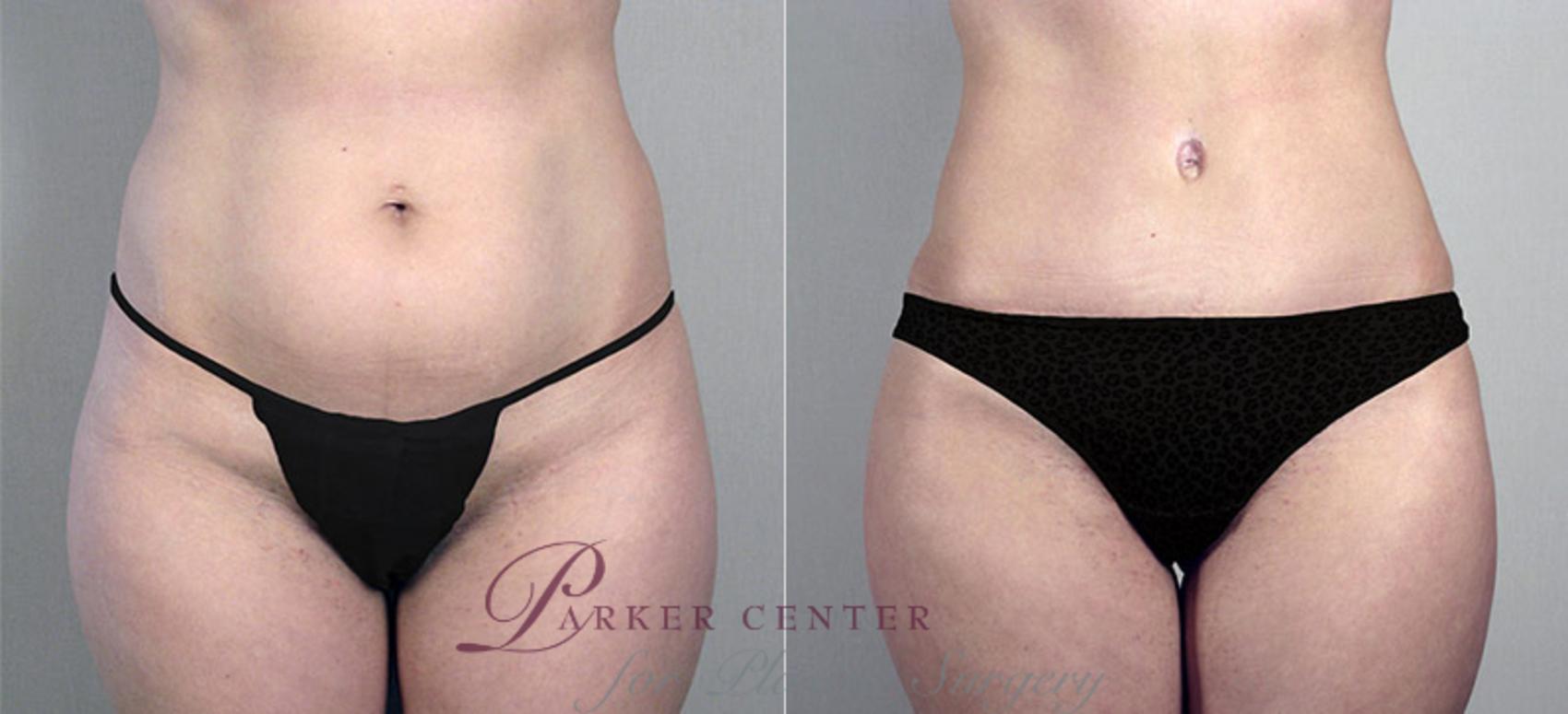 Liposuction Case 694 Before & After View #3 | Paramus, NJ | Parker Center for Plastic Surgery