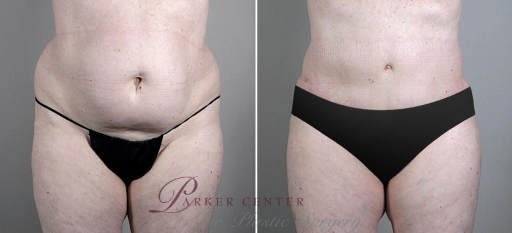 Liposuction Case 696 Before & After View #1 | Paramus, NJ | Parker Center for Plastic Surgery