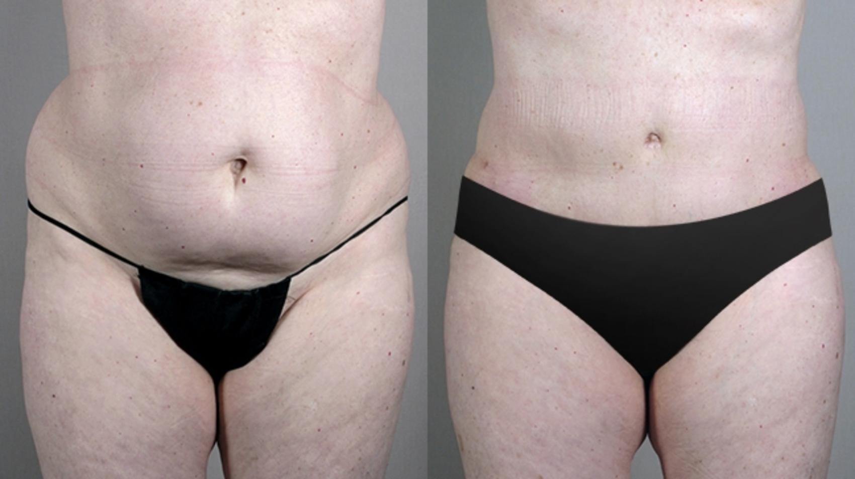 Tummy Tuck Case 696 Before & After View #1 | Paramus, NJ | Parker Center for Plastic Surgery