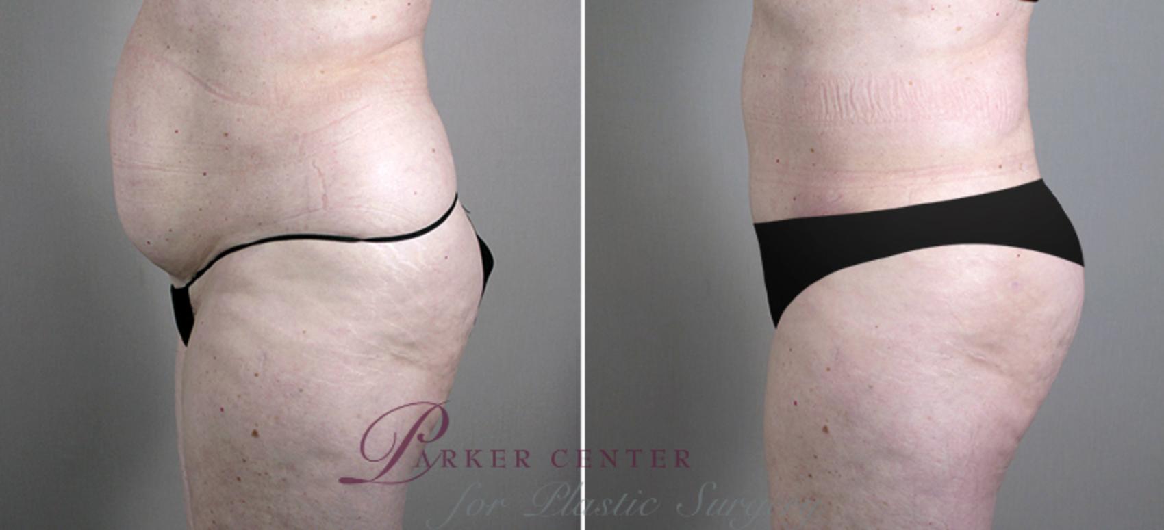 Liposuction Case 696 Before & After View #2 | Paramus, NJ | Parker Center for Plastic Surgery