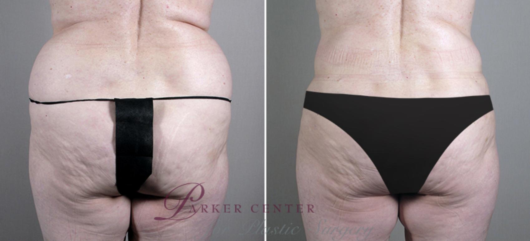 Liposuction Case 696 Before & After View #3 | Paramus, NJ | Parker Center for Plastic Surgery