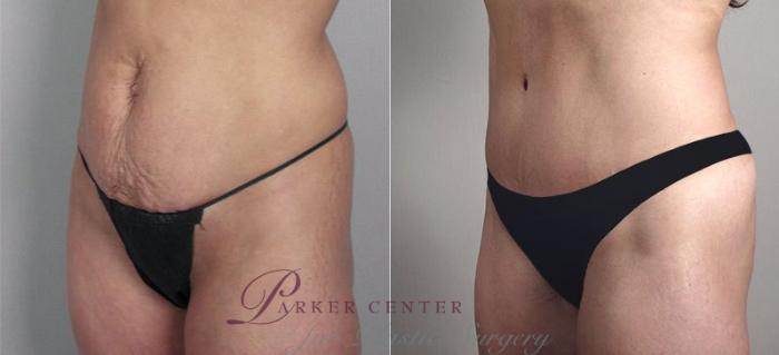 Liposuction Case 697 Before & After View #1 | Paramus, NJ | Parker Center for Plastic Surgery