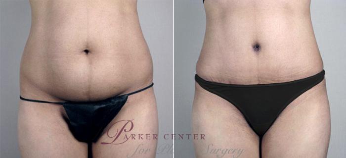 Liposuction Case 698 Before & After View #1 | Paramus, NJ | Parker Center for Plastic Surgery