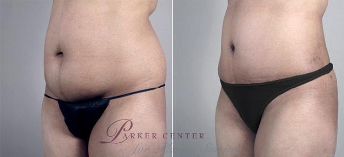 Liposuction Case 698 Before & After View #2 | Paramus, NJ | Parker Center for Plastic Surgery